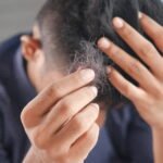 Understanding COVID Hair Loss Treatment: Causes, Solutions, And Recommendations